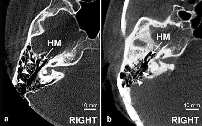 Diagnostic axial Cone Beam Computed Tomography (CBCT) scans of the right temporal bone, focused on the mastoid region at the anatomical level of the head of the malleus (HM). The images illustrate the morphology of Körner's septum (KS), a persistent petrosquamosal suture that acts as a surgical landmark within the mastoid antrum. Image (a) demonstrates a 'complete' Körner's septum, characterized by a continuous, well-defined bony lamina (indicated by white arrowheads) that extends posterior to the head of the malleus, effectively compartmentalizing the mastoid air cells into superficial (squamous) and deep (petrous) portions. Image (b) shows an 'incomplete' Körner's septum, where the bony lamina is fragmented or less extensive, lacking full division of the mastoid cellularity. These radiological findings are clinically significant for otologic surgeons, particularly during mastoidectomy, as the presence of a complete septum can mimic the medial wall of the antrum and potentially obscure deeper anatomical structures like the lateral semicircular canal or the facial nerve.