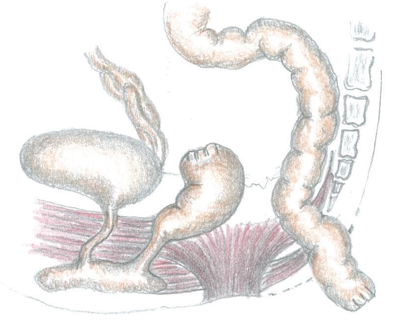 This medical illustration depicts a surgical stage of a posterior sagittal anorectoplasty (PSARP) for the management of a congenital anorectal malformation. The diagram shows the pelvic anatomy from a lateral-posterior perspective. Central to the image is the mobilized sigmoid colon, shown as a long, haustrated tubular structure being transitioned toward the posterior sagittal space. To the left, the urinary bladder is visualized with its connection to the lower urinary tract. Adjacent to it is a blind-ending distal rectal pouch, which has been surgically separated from the proximal bowel. The pelvic floor musculature, including the levator ani and muscle complex, is rendered in red, illustrating the tunnel created for the pull-through procedure. On the right, the sacrum and vertebral column serve as anatomical landmarks, highlighting the retrorectal pathway used for the sigmoid mobilization. This educational illustration demonstrates the surgical technique of bypassing a dilated rectum to utilize the healthy sigmoid colon for neo-anus construction.