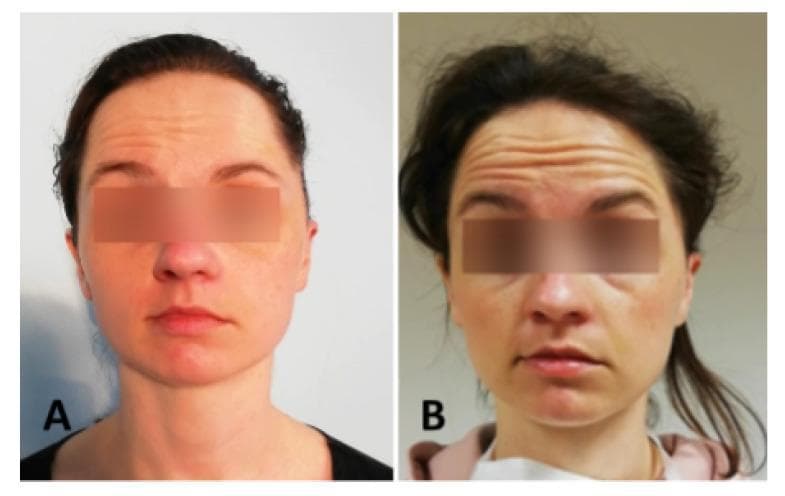 Clinical photograph comparing two stages of facial nerve dysfunction in a patient during an eyebrow elevation exercise. Image (A) represents a House-Brackmann (HB) grade VI classification, demonstrating total paralysis on the patient's left side with a complete absence of forehead wrinkling and eyebrow movement, resulting in marked asymmetry. Image (B) represents an HB grade III classification, showing moderate improvement in mimetic muscle function. In this stage, there is visible, though still asymmetric, forehead wrinkling and a noticeable arching/elevation of the eyebrows. The comparison illustrates the clinical assessment of the frontalis muscle and the cranial nerve VII (facial nerve) recovery process. The visual demonstrates key diagnostic indicators used in grading systems, such as the depth of forehead rhytids and the excursion distance of the eyebrows relative to the eyes.