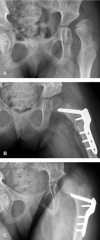 This series of three anteroposterior radiographs documents the surgical management and progression of hip subluxation in an 8-year-old female patient with cerebral palsy (GMFCS level V). Image A (preoperative) demonstrates severe lateral and superior subluxation of the left femoral head relative to the dysplastic acetabulum, characterized by a Migration Percentage (MP) of 74%. Image B, captured 6 weeks postoperatively, shows significant improvement in femoral head coverage and joint congruency following a combined femoral varus derotation osteotomy (VDRO) and Dega-type pelvic osteotomy. Orthopedic hardware, specifically a locked compression plate with multiple screws, is visible providing internal fixation on the proximal femur. Image C, taken 2.9 years postoperatively, illustrates a clinical relapse of the hip subluxation (MP 51%). The femoral head has migrated laterally despite the continued presence of the surgical hardware, indicating loss of correction over time. This comparison highlights the challenges of maintaining hip stability in non-ambulatory pediatric patients with neuromuscular conditions.