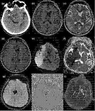 This composite of clinical diagnostic images illustrates an acute ischemic stroke with subsequent hemorrhagic transformation in a 64-year-old male. (a) Non-contrast axial CT scan demonstrates a hyperdense middle cerebral artery (MCA) sign on the right, indicating acute thrombus. (b–d) Sequential MRI sequences including T1-weighted, T2-weighted, and FLAIR imaging at 24 hours post-onset show an evolving infarct in the right cerebral hemisphere characterized by abnormal signal intensity and sulcal effacement. (e, f) Diffusion-weighted imaging (DWI) and corresponding ADC mapping confirm cytotoxic edema with restricted diffusion in the affected territory. (g, h) Susceptibility-weighted imaging (SWI) reveals hypointense signals within the right thalamus, diagnostic of secondary intraparenchymal hemorrhage. (i) Magnetic resonance angiography (MRA) provides a vascular overview, showing complete occlusion of the right internal carotid artery (ICA) and MCA, alongside multi-vessel stenoses in the anterior, posterior, and contralateral middle cerebral arteries. This case highlights the radiological progression from large vessel occlusion to significant cerebral infarction and hemorrhagic transformation.