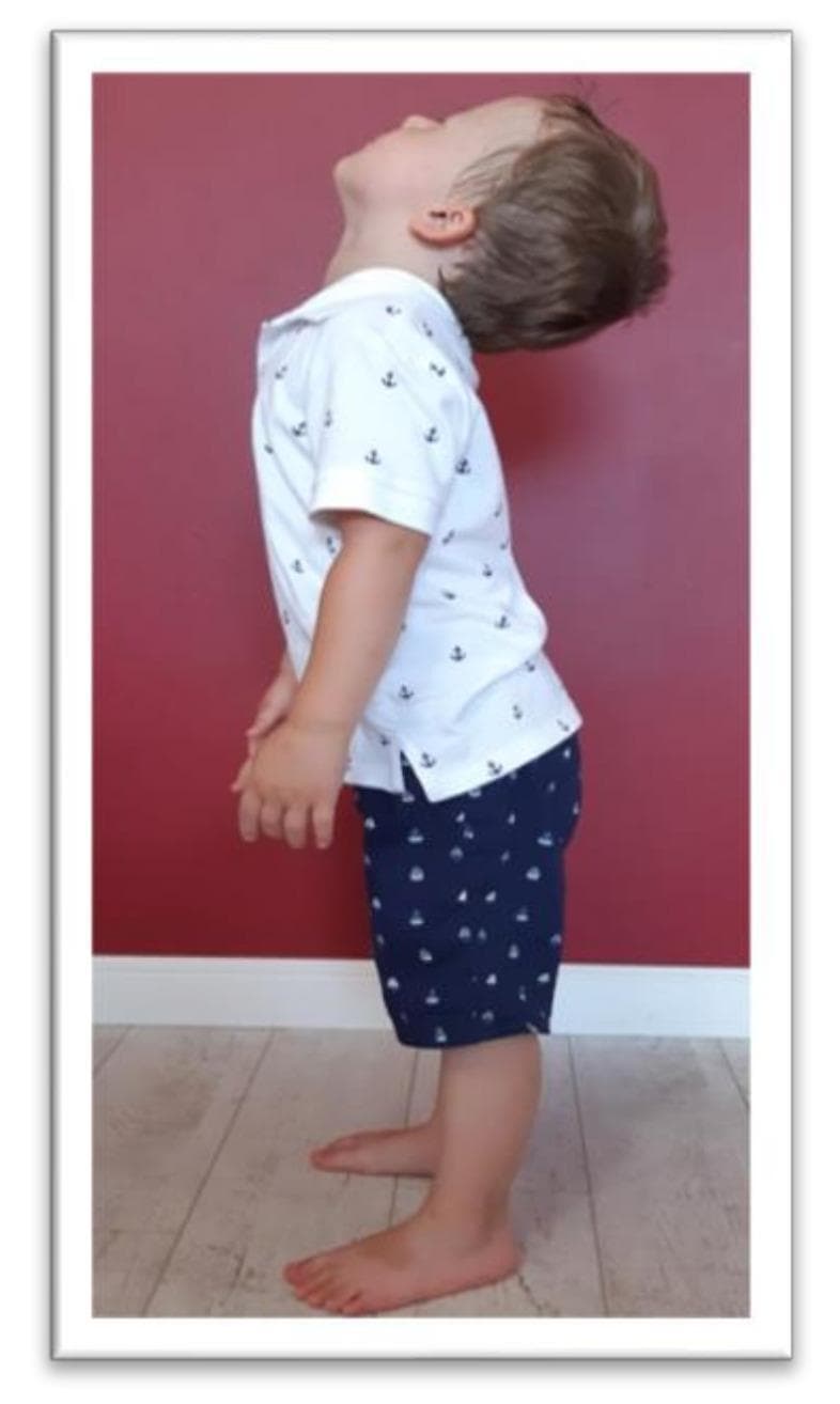 This clinical photograph shows a young child in a standing position, illustrating the examination procedure for the Tonic Labyrinthine Reflex (TLR) in extension. The child is positioned laterally to the camera, demonstrating a significant posterior tilt of the head (neck extension) and an upright torso. The arms hang naturally at the sides, and the feet are flat on the floor, slightly apart. The visual focus is on the body's posture in response to the change in head position, which is used in pediatric neurology and physical therapy to assess the integration of primary reflexes. Incomplete integration of the TLR is suggested if head extension triggers compensatory movements such as total body extension, limb straightening, or a loss of balance. This image serves as an educational reference for clinicians identifying motor reactions related to the vestibular system and brainstem-mediated primitive reflexes during childhood development assessments.