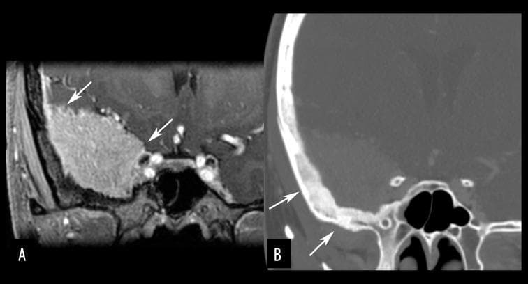 This composite diagnostic image features a skull base meningioma in a 29-year-old female, illustrating key radiological signs on MRI and CT. Image A is a coronal-reformatted, post-contrast T1-weighted MRI showing a well-circumscribed, homogeneously enhancing mass at the skull base with a broad dural attachment. Arrows highlight a 'dural tail sign,' characterized by linear thickening and enhancement of the adjacent dura mater. Image B is a coronal-reformatted bone window CT at the same level, which demonstrates significant hyperostosis (reactive bone thickening and increased density) of the underlying sphenoid bone (arrows) directly adjacent to the tumor. These findings are classic for meningioma, where dural tail enhancement suggests neoplastic or reactive dural infiltration, and hyperostosis reflects a common osteoblastic response of the skull base to the tumor. This visual set is essential for teaching the combined soft tissue and osseous manifestations of extra-axial skull base neoplasms in neuroradiology.