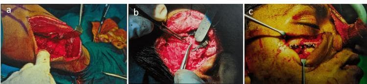 A series of three intraoperative clinical photographs (a, b, and c) documenting the stages of a microvascular free fibular bone graft for midface reconstruction. Image (a) depicts the donor site harvest from the lower leg; surgical retractors expose the fibula and associated soft tissues, where an acrylic template is used to guide osteotomy for graft sizing. Image (b) shows the microsurgical stage at the recipient site in the temporal region, involving the end-to-side anastomosis of the fibular graft pedicle (peroneal artery and vein) to the superficial temporal vessels using fine microsurgical instruments. Image (c) shows the final reconstruction of the right maxilla/midface region. A stainless steel six-hole straight miniplate and fixation screws secure the fibular bone graft into the surgical defect. Key visible landmarks include the patient's closed eye, an elevated facial skin flap, and surgical retractors maintaining the field of view. The clinical sequence illustrates the transition from donor site harvesting to microvascular revascularization and final orthopedic stabilization in craniomaxillofacial surgery.
