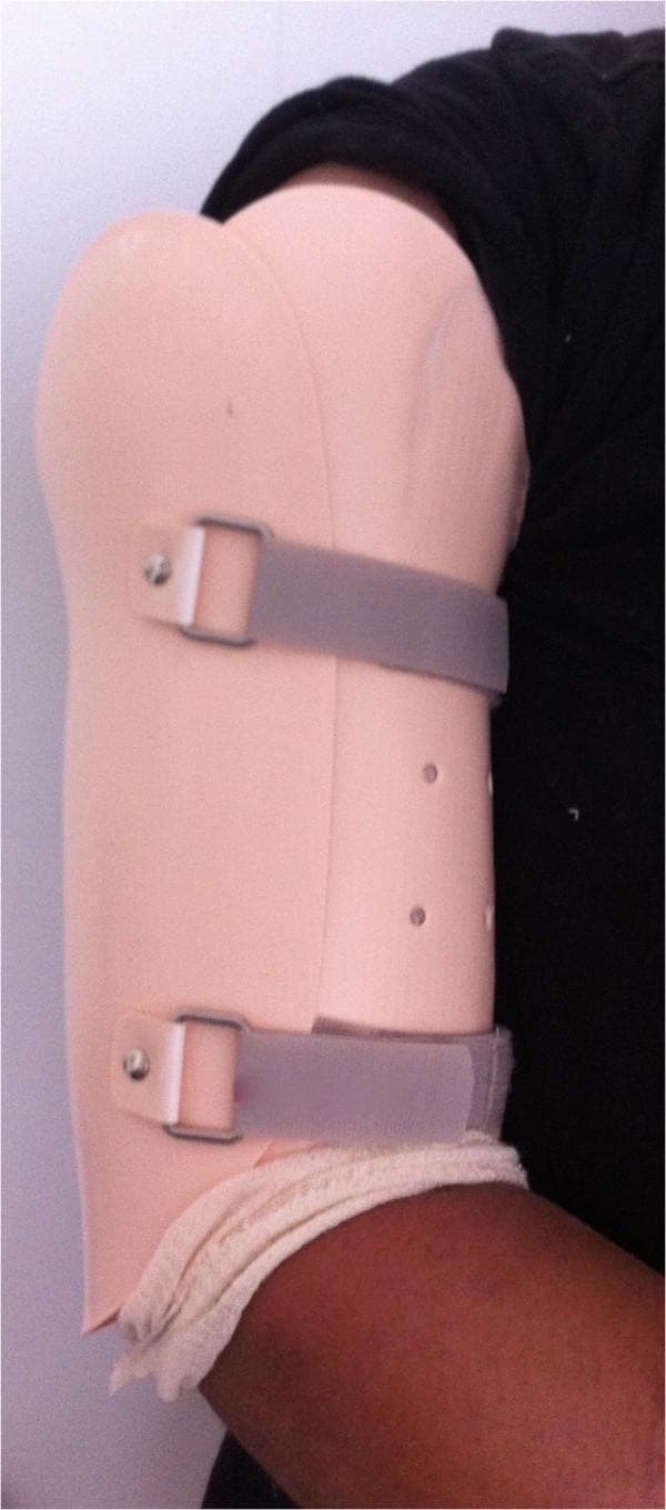 This clinical photograph shows a functional humeral brace, also known as a Sarmiento brace, applied to the upper arm of a patient. The brace is a rigid, pink-toned thermoplastic orthosis designed to provide circumferential compression of the arm while allowing for range of motion at the shoulder and elbow joints. The orthosis features a contoured proximal edge that extends toward the deltoid region and is secured by two grey adjustable straps with metal D-ring fasteners and rivets. Multiple small ventilation holes are visible on the lateral aspect of the shell to promote airflow. Beige soft padding is visible at the distal margin near the elbow to protect the skin and improve patient comfort. This type of device is typically used for the conservative management of humeral shaft fractures, utilizing the principle of soft tissue compression to stabilize the fracture site during the consolidation phase.