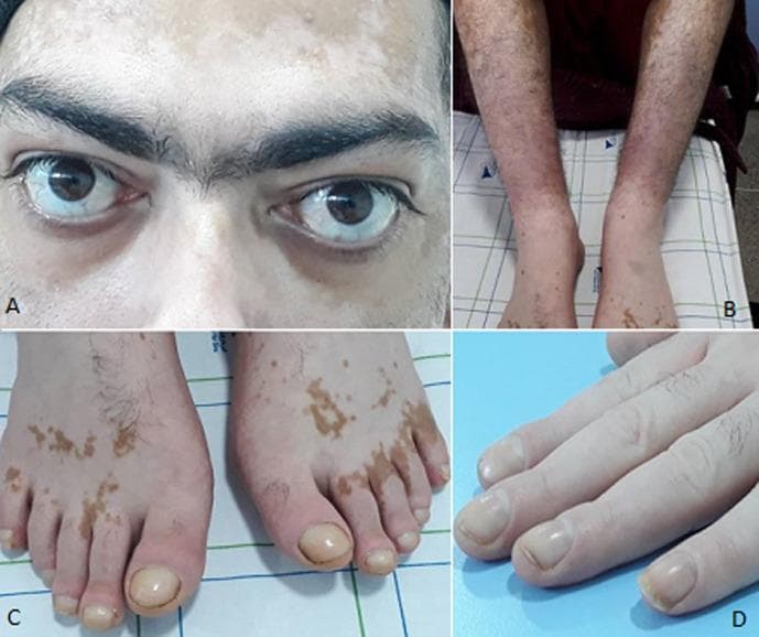This composite clinical photograph illustrates the classic triad of extra-thyroidal manifestations associated with Graves' disease (Basedow's disease). Panel A shows bilateral exophthalmos (proptosis) and scleral show, along with periocular depigmentation consistent with vitiligo. Panel B demonstrates pretibial myxedema (thyroid dermopathy), characterized by diffuse, brawny, brownish-red induration and hyperpigmentation of the lower legs. Panels C and D display thyroid acropathy, a rare manifestation of Graves' disease. Notable features include digital clubbing (hippocratisme digital) of both fingers and toes, visible as bulbous swelling of the distal phalanges and increased convex curvature of the nail plates. Additionally, the skin on the dorsal aspect of the feet shows patchy, well-defined hyperpigmentation and hypopigmentation. This image serves as a comprehensive educational reference for the systemic dermatological and ophthalmological complications of autoimmune hyperthyroidism, highlighting the characteristic triad of exophthalmos, dermopathy, and acropathy.