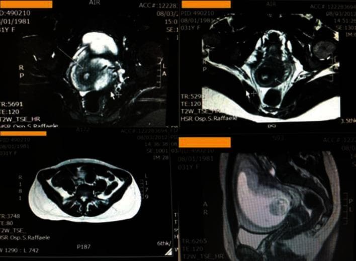 This diagnostic image set consists of pelvic Magnetic Resonance Imaging (MRI) scans in axial and sagittal planes, likely T2-weighted sequences (T2W TSE HR). The images focus on the female pelvic anatomy, specifically the uterus and cervix in a pregnant patient. A mild hyperintense signal is visible in the posterior-left and anterior aspects of the cervix, indicated by arrows. This signal abnormality extends toward the outer cervical border. The surrounding parametrium shows no signs of infiltration, maintaining clear fat planes. The left vaginal fornix appears minimally thickened without abnormal signal intensity. Other pelvic structures, including the ovaries and the gravid uterus, show normal morphology for gestational age without evidence of lymphadenopathy in the pelvic or lumbar-aortic regions. These findings were documented in a clinical case of primary cervical schwannoma, highlighting the importance of MRI in evaluating localized cervical lesions and their relationship to adjacent structures during pregnancy.