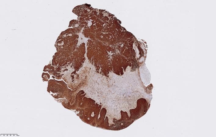 This diagnostic image shows a low-magnification view of a laryngeal squamous cell carcinoma (LSCC) tissue sample undergoing p16 immunohistochemistry (IHC) staining. The micrograph demonstrates a high expression level of the p16 protein, indicated by the intense, diffuse brown chromogen staining throughout the tumor nests. This specific sample is classified with a maximum Quickscore of 18, reflecting both a high proportion of stained cells (score 6) and strong staining intensity (score 3). The staining pattern is heterogeneous, with dense, dark brown regions corresponding to high p16 expression in neoplastic cells and lighter, pale brown or nearly clear areas representing the surrounding connective tissue stroma or necrotic regions. The distribution of the IHC signal helps clinicians and pathologists assess the p16 status, which is often used as a surrogate biomarker for high-risk Human Papillomavirus (HPV) infection in squamous cell carcinomas of the head and neck. The irregular boundary between the strong brown staining and the stroma highlights the infiltrative nature of the malignant cells.
