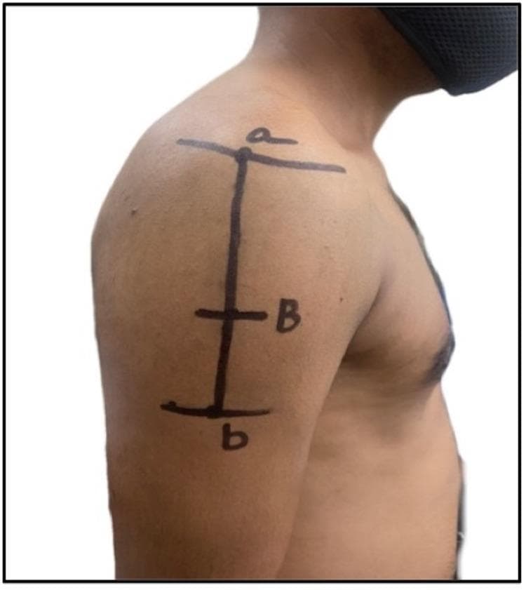 This clinical photograph illustrates the surface anatomy and landmarks for identifying safe intramuscular injection (IMI) sites in the deltoid muscle region. Black ink markings on the subject's right lateral shoulder and upper arm delineate anatomical references and distance measurements. A superior horizontal line marked 'a' indicates the lateral border of the acromion process. A vertical line descends from this point toward the inferior aspect of the deltoid. A midpoint intersection marked 'B' represents a distance of 7.4 cm from the acromion border, identified as a safe zone for injection to avoid the subacromial bursa and the axillary nerve. A final horizontal line and label 'b' at the base of the vertical markings indicate the deltoid tuberosity, the muscle's distal insertion point. The image serves as an educational guide for healthcare professionals to visualize the neurovascular 'danger zones' (proximal humerus surgical neck, axillary nerve, and posterior circumflex humeral artery) versus safer distal sites for vaccine or medication administration.