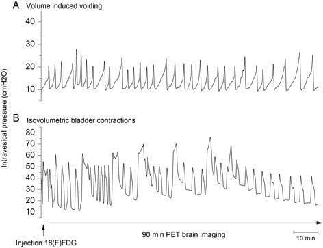This diagnostic comparison chart displays two cystometrogram (CMG) plots recording intravesical pressure (cmH2O) over a 90-minute temporal duration, synchronized with (18F)FDG-PET brain imaging. Plot A illustrates volume-induced voiding, characterized by regular, rhythmic sawtooth pressure fluctuations ranging between 10 and 30 cmH2O. This pattern reflects a consistent cycle of bladder filling and reflexive emptying. Plot B displays isovolumetric bladder contractions, which exhibit significantly higher pressure amplitudes, reaching up to 70–80 cmH2O. The contractions in the isovolumetric state are more irregular and show a gradual decline in both amplitude and frequency toward the end of the 90-minute session, suggesting detrusor muscle fatigue or adaptive mechanisms. The visual data is essential for understanding the neurophysiological and mechanical differences between normal micturition cycles and states of obstructed or constrained bladder outflow. This content is relevant for urology and functional neuroimaging education, focusing on lower urinary tract (LUT) physiology.