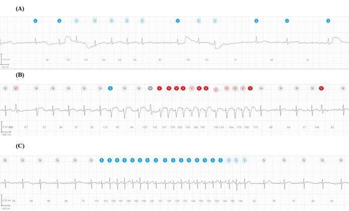 A comparative clinical diagnostic image featuring three single-lead ECG rhythm strips (A, B, and C) recorded by a wearable patch device, demonstrating different cardiac arrhythmias. Each strip includes automated annotations: 'N' (gray) for normal beats, 'V' (red) for ventricular beats, and 'S' (blue) for supraventricular/atrial events. (A) Displays Atrial Fibrillation, characterized by an irregularly irregular rhythm, absent P waves, and a fluctuating baseline with variable QRS amplitudes. (B) Shows Nonsustained Ventricular Tachycardia (NSVT), evidenced by a sudden burst of rapid, wide QRS complexes (annotated with 'V') transitioning from and back to a normal sinus rhythm. (C) Illustrates Atrial Tachycardia, depicting a rapid, regular narrow-complex tachycardia with a series of blue 'S' annotations indicating a sustained atrial ectopic rhythm before returning to normal beats. The image serves as an educational tool for identifying common arrhythmias and understanding the application of automated rhythm classification in mobile health monitoring.