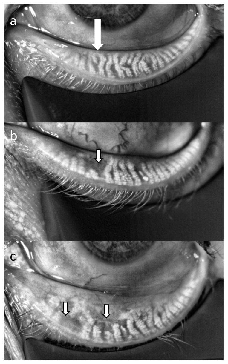 This diagnostic image displays three infrared meibography panels (a, b, and c) of the lower eyelid, illustrating the progression of Meibomian gland dysfunction (MGD). Panel (a) shows healthy Meibomian glands characterized by a dense, parallel, and organized array of hyperreflective elongated structures extending vertically toward the eyelid margin. In panel (b), representing mild MGD, there is a visible disruption in gland continuity and density, with subtle areas of glandular thinning indicated by an arrow. Panel (c) demonstrates moderate MGD, where significant pathology is evident through widespread gland dropout and architectural distortion. The arrows in (c) highlight dark, hyporeflective regions representing the loss of functional glandular tissue. This comparison serves as an educational tool for ophthalmology to identify different stages of Meibomian gland atrophy and calculate meiboscores. The images were captured using infrared interferometry, highlighting the autofluorescence of healthy meibum against the atrophied areas.