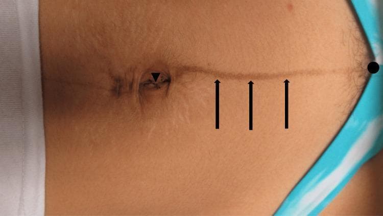Clinical photograph of a female patient's abdomen demonstrating linea nigra, a common form of physiological hyperpigmentation. The image shows a vertically oriented, tan-to-brown linear streak extending along the midline. Black markers highlight key anatomical landmarks: a triangle at the umbilicus, arrows pointing to the hyperpigmented line, and a circle indicating the termination point near the pubic symphysis. The pigmentation is also visible within and slightly superior to the umbilical region. Secondary skin findings include subtle, light-colored striae distensae (stretch marks) radiating from the umbilicus and periumbilical area. The clinical presentation is characteristic of pregnancy-induced cutaneous changes, specifically the darkening of the linea alba due to increased melanocyte-stimulating hormone. This photograph serves as an educational resource for identifying benign pregnancy-related dermatological conditions and their characteristic anatomical distribution.