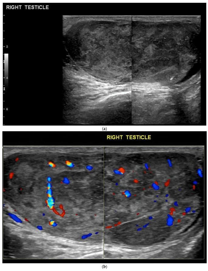 Two-panel diagnostic ultrasound of the right testicle showing a primary testicular tumor. (a) B-mode (grayscale) ultrasound reveals a large, heterogeneous, predominantly hypoechoic mass that infiltrates and expands the testicular parenchyma. The mass contains internal echogenic foci consistent with macrocalcifications and small anechoic cystic areas. (b) Color Doppler ultrasound demonstrates significant hypervascularity within the lesion, characterized by multiple red and blue flow signals distributed throughout the mass. This appearance is characteristic of germ cell tumors, such as seminoma or embryonal cell carcinoma, which typically present as hypervascular, ill-defined solid masses. The imaging highlights the role of ultrasound in distinguishing solid neoplastic lesions from avascular pathologies like hematomas or simple cysts. The case is representative of urological oncology teaching materials for identifying signs of testicular malignancy.