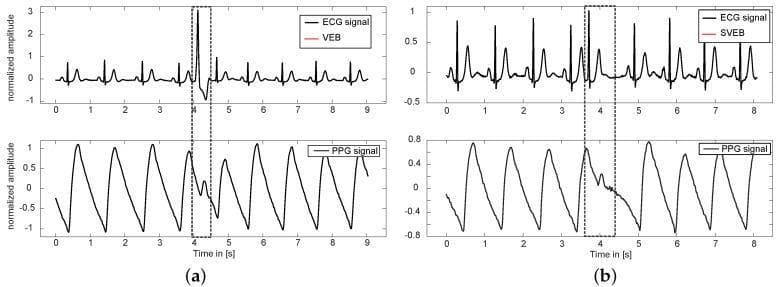 This Comparison Chart displays synchronized waveforms of Electrocardiography (ECG) and Photoplethysmography (PPG) to illustrate the effects of cardiac arrhythmias on arterial pulse waves. Panel (a) shows a Premature Ventricular Ectopic Beat (VEB) occurring at t=4s, characterized by a high-amplitude, widened, and distorted QRS complex on the ECG, which correlates with a significant reduction in amplitude and a notched morphology in the corresponding PPG pulse wave. Panel (b) illustrates a Premature Supraventricular Ectopic Beat (SVEB) at t=3.8s, where the ECG morphology remains relatively similar to normal beats, but the PPG signal exhibits a diminished amplitude and an irregular, notched peak. Both examples demonstrate how ectopic beats lead to decreased left ventricular stroke volume and arterial pulse degradation, complicating automated heart rate monitoring and Pulse Arrival Time (PAT) estimation. The charts use normalized amplitude on the y-axis and time in seconds on the x-axis, highlighting the diagnostic challenges posed by premature beats in synchronized cardiovascular signal analysis.