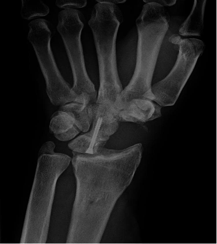 This anteroposterior (AP) radiograph of the wrist demonstrates a status post-surgical intervention for advanced carpal collapse, specifically a capitolunate arthrodesis (fusion). A single orthopedic headless compression screw is visible, traversing longitudinally from the lunate into the capitate to facilitate stable fusion. There is a notable absence of the scaphoid bone, consistent with a total scaphoid excision. The distal radius is seen articulating directly with the lunate. The surrounding carpal architecture shows the triquetrum and hamate in situ, though the normal proximal carpal row alignment is altered due to the excision and fusion. This procedure is typically indicated for treating advanced Scapholunate Advanced Collapse (SLAC) or Scaphoid Nonunion Advanced Collapse (SNAC) to preserve wrist motion while addressing degenerative arthritis.