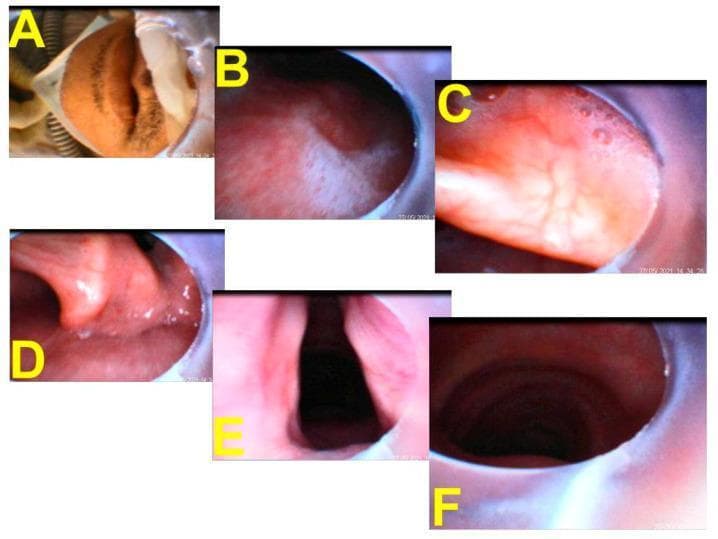 This composite of endoscopic images illustrates a serial pictorial progression of tracheal intubation using a video-assisted intubating stylet (Shikani technique). (A) Shows the clinical context of the patient receiving high-flow nasal cannula (HFNC) treatment just prior to insertion. (B) Displays the pharyngeal view with visible mucus and saliva at the start of the procedure. (C) Provides a close-up of the vallecula as the stylet advances. (D) Visualizes the corniculate and cuneiform cartilages of the posterior larynx. (E) Offers a clear, full view of the glottic opening and vocal cords, representing the target for endotracheal tube (ETT) placement. (F) Confirms successful placement by visualizing the internal tracheal rings and the distal tip of the ETT within the trachea. The images demonstrate the necessary anatomical landmarks for safe airway management, including the transition from the oropharynx through the glottis and into the subglottic space. This series is an educational example of real-time visualization used to guide airway management in high-risk patients, such as those with severe respiratory infections requiring rapid ventilator support.