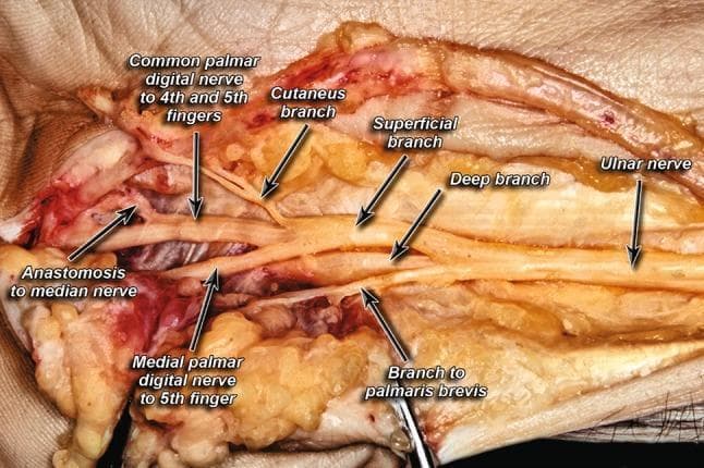 This clinical photograph displays a high-resolution cadaveric dissection of the ulnar nerve and its branching patterns within the hand, specifically focused on the distal forearm and palmar regions. The image serves as an anatomical diagram of the peripheral nervous system, illustrating the ulnar nerve bifurcating into its primary deep and superficial branches. Key anatomical landmarks identified through labeling include the cutaneous branch, the muscular branch to the palmaris brevis, and the medial palmar digital nerve to the 5th finger. Of particular educational significance is the visualization of the common palmar digital nerve to the 4th and 5th fingers and a notable anastomosis connecting the ulnar digital branches to the median nerve. This image is essential for understanding the neuroanatomy of the hand, Guyon's canal variations, and clinical scenarios involving ulnar nerve entrapment or surgical decompression. The content is suitable for medical students and surgical residents studying upper extremity anatomy and peripheral nerve variations.