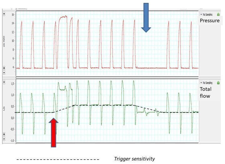 This diagnostic visualization consists of two stacked ventilator waveforms illustrating the impact of air leakage on flow-triggering sensitivity. The upper graph displays Pressure (cm H2O) over time, showing cyclical pressure-supported breaths ranging from approximately 4 to 16 cm H2O. The lower graph displays Total Flow (L/s) over time, with values ranging from -1.0 to 1.5 L/s. A horizontal dashed line superimposed on the flow graph represents the dynamic trigger sensitivity threshold. The red arrow highlights a point where a sudden increase in baseline flow (leakage) causes the ventilator to auto-trigger several breaths until the algorithm adjusts by raising the sensitivity threshold. The blue arrow indicates the withdrawal of the leak, causing a temporary lapse in triggering (ineffective efforts) as the sensitivity threshold gradually resets to the lower baseline. This figure demonstrates the compensatory logic used in non-invasive ventilation (NIV) to maintain synchrony during fluctuating leak conditions.