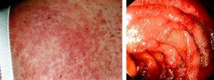This dual-panel clinical image illustrates manifestations of acute graft-versus-host disease (GVHD) in the skin and gastrointestinal tract. The left panel shows a clinical photograph of a widespread, diffuse erythematous maculopapular rash on the skin. The lesions consist of numerous small, red macules and papules that are confluent in some areas, creating a mottled appearance. The right panel is an endoscopic image of the upper intestinal mucosa. It reveals severe mucosal inflammation characterized by intense erythema, edema (swelling), and friability. The normally distinct mucosal folds appear thickened and rounded, with surface irregularities and a glistening appearance suggestive of increased mucus production or exudate. Together, these panels demonstrate the multisystemic nature of acute GVHD following hematopoietic cell transplantation, highlighting the visual diagnostic criteria for skin and mucosal involvement.