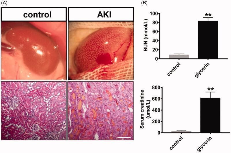 This composite educational image illustrates a rodent model of Acute Kidney Injury (AKI) induced by glycerol. Panel A presents side-by-side macroscopic and microscopic comparisons between a control and an AKI kidney. Macroscopically, the control kidney appears smooth and normal in size, while the AKI kidney exhibits significant enlargement (hypertrophy), a textured pale surface, and focal areas of hemorrhage. The corresponding histology (H&E staining, bar: 100μm) shows that the control tissue maintains organized tubular structures, whereas the AKI tissue demonstrates extensive pathology, including tubular dilatation, vacuolation, atrophy, and the presence of intratubular myoglobin casts characteristic of rhabdomyolysis-induced renal damage. Panel B provides quantitative data via bar charts, showing a marked, statistically significant increase in biochemical markers of renal dysfunction in the AKI (glycerin) group: Blood Urea Nitrogen (BUN) levels exceed 80 mmol/L and serum creatinine levels reach approximately 600 μmol/L, compared to the low baseline levels in the control group. This visual summary effectively demonstrates the correlation between macroscopic organ changes, histopathological tissue damage, and clinical biomarkers in acute nephrotoxicity.