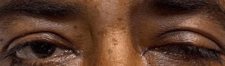 This clinical photograph displays a close-up view of the periocular region of a patient, demonstrating bilateral blepharoptosis (drooping eyelids). The content type is a Clinical Photograph within the specialty of Neurology or Ophthalmology. The image shows asymmetrical involvement, with the left upper eyelid exhibiting a more severe degree of ptosis compared to the right, significantly obscuring the left pupil and reducing the vertical palpebral fissure height. This visual finding is a classic sign often associated with Myasthenia Gravis (MG). The skin shows normal texture and color for the patient's ethnicity, without obvious signs of local inflammation or edema. This image serves as a baseline for clinical assessment, specifically to be compared against post-intervention results such as an ice pack test or Tensilon test to evaluate for fatigable muscle weakness and diagnostic confirmation of neuromuscular junction disorders.