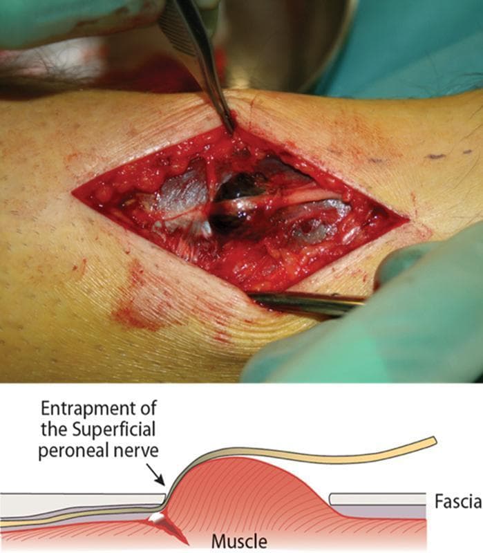 This clinical photograph and accompanying anatomical diagram illustrate an intraoperative view of the distal lateral leg during a fasciotomy for compartment syndrome. The clinical image shows a longitudinal surgical incision exposing the underlying muscle fascia and neurovascular structures. A prominent localized dark-red hematoma is visible within the surgical field, indicating acute trauma. The superficial peroneal nerve (SPN) is seen coursing through the incision site, appearing compressed and entrapped against the fascial opening. The underlying peroneus tertius muscle demonstrates significant disruption, consistent with rupture and herniation through the fascia. The anatomical diagram below the photograph provides a cross-sectional schematic of the pathology, highlighting how muscle herniation causes mechanical entrapment of the SPN against the rigid edge of the fascia. This visual material is used in surgical education to demonstrate the mechanical etiology of nerve entrapment secondary to muscle trauma and the subsequent need for surgical decompression and fasciotomy.