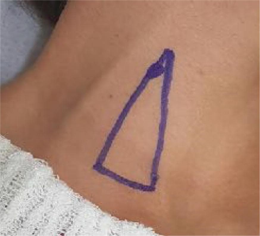 This clinical photograph displays a close-up view of a patient's neck in the dorsal decubitus position, rotated contralaterally to expose the right cervical region. A blue ink marking delineates a triangle representing Sedillot's triangle, an anatomical landmark used for internal jugular vein (IJV) cannulation via the traditional technique (TT). The base of the triangle is situated inferiorly near the clavicle, while the two ascending sides correspond to the sternal and clavicular heads of the sternocleidomastoid muscle. The apex of the triangle is positioned superiorly where these two muscle heads converge. A specific circular mark near the apex indicates the intended puncture point for vascular access, which is clinically localized lateral to the palpated common carotid artery (CCA) pulse. The image serves as an educational guide for identifying superficial anatomical landmarks necessary for central venous catheterization and highlights the surface anatomy used in blind or ultrasound-guided vascular procedures within the field of anesthesiology and critical care.