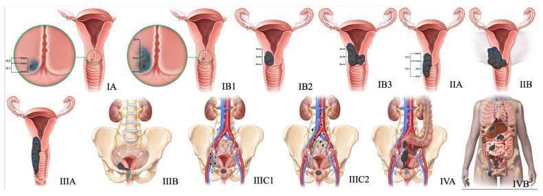 Anatomical diagrams illustrating the 2018 FIGO staging system for cervical cancer, progressing from Stage IA to IVB. The top row depicts cervical and vaginal spread: Stage I is confined to the cervix with subdivisions based on depth (IA) and diameter (IB1-IB3); Stage II shows extension beyond the uterus into the upper two-thirds of the vagina (IIA) and parametrial invasion (IIB). The bottom row illustrates advanced regional and distant spread: Stage IIIA involves the lower one-third of the vagina, while IIIB shows extension to the pelvic sidewall and associated hydroureter/hydronephrosis. Stage IIIC indicates lymphatic involvement, further categorized into pelvic (IIIC1) and para-aortic (IIIC2) lymph nodes. Stage IV demonstrates local invasion of the bladder or rectum (IVA) and distant metastasis beyond the pelvis (IVB). Key anatomical landmarks included are the uterus, cervix, vagina, ureters, kidneys, pelvic bones, and major blood vessels. The diagrams use color-coded masses to represent tumor growth and invasion depth, serving as a comprehensive educational guide for gynecologic oncology staging.