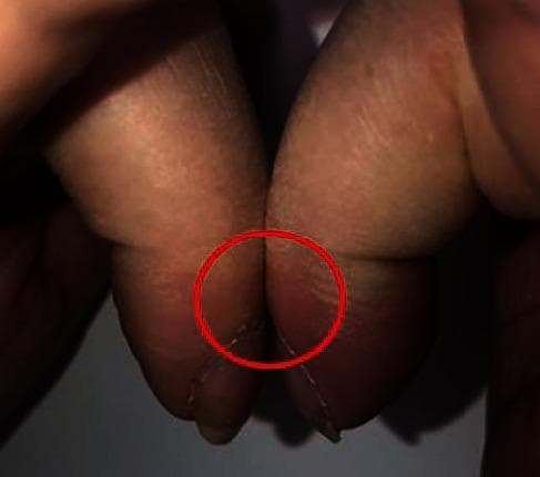 This clinical photograph displays a positive Schamroth sign, a classic physical examination finding indicative of digital clubbing (acropachy). The image shows the dorsal surfaces of the terminal phalanges of two opposite fingers placed in close apposition. In a normal presentation, a small diamond-shaped window (Schamroth's window) is visible between the nail beds; however, in this case, the window is absent. The nail beds are in direct contact, highlighted by a red circle, demonstrating the obliteration of the normal angle. The skin at the base of the nails appears thickened and shiny, consistent with the bulbous swelling seen in hypertrophic osteoarthropathy. This sign is clinically significant as an indicator of underlying chronic conditions, such as pulmonary or cardiovascular diseases, or in this context, paraneoplastic syndromes associated with metastatic malignancy.