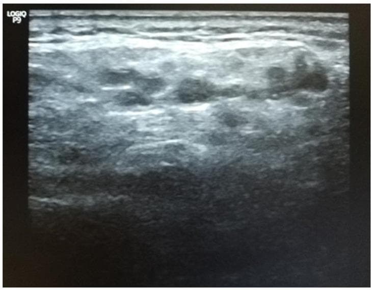 A diagnostic B-mode ultrasound image of a major salivary gland, likely the parotid gland, demonstrating severe pathological changes characteristic of chronic inflammatory conditions such as Sjögren's syndrome. The image exhibits Grade 3 severe architectural distortion, characterized by a diffuse, inhomogeneous parenchymal echotexture. Multiple well-defined anechoic to hypoechoic (darker) areas are distributed throughout the entire surface of the gland, representing lymphocytic infiltration or cystic dilatation of the ducts. These dark regions are separated and surrounded by hyperechoic (bright) linear bands, which represent fibrotic tissue or thickened septa. The glandular margins are poorly defined as the abnormal echogenicity extends into the surrounding soft tissue. This visual pattern is a key diagnostic indicator in rheumatology and oral medicine for evaluating the extent of glandular destruction and assessing systemic autoimmune disease involvement.
