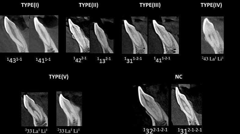 This diagnostic composite image presents sagittal Cone Beam Computed Tomography (CBCT) scans of human mandibular anterior teeth, illustrating root canal morphology variations. The visual is categorized according to the Vertucci classification (Types I, II, III, IV, and V) and the Ahmed classification system. Type I shows a single canal from pulp chamber to apex (1-1 configuration). Type II shows two canals merging into one (2-1). Type III depicts a single canal bifurcating into two then rejoining as one (1-2-1). Type IV demonstrates two independent canals from chamber to apex (2-2). Type V illustrates a single canal dividing near the apex into two distinct foramina (1-2). An additional 'NC' (Non-Classifiable) section displays complex variations like the 2-1-2-1 configuration. These images serve as educational resources for endodontics, highlighting the anatomical complexity of root canal systems necessary for successful dental treatment planning and biomechanical preparation.