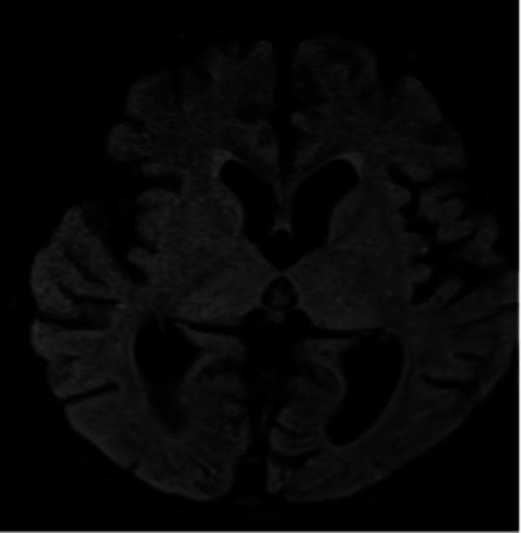 This diagnostic image is an axial MRI scan of the brain, specifically illustrating neuroanatomical changes associated with rabies encephalitis. The scan demonstrates diffuse cerebral atrophy, evidenced by prominent sulci and a generalized reduction in brain parenchyma volume. Associated with this tissue loss is ex-vacuo ventriculomegaly, characterized by the enlargement of the lateral and third ventricles. Pathological signal alterations are visible as hyperintensities in the bilateral thalami (deep gray matter nuclei) and bilateral peri-trigonal white matter, extending into the deep frontal regions. These findings represent the typical inflammatory and degenerative progression of viral encephalitis. The imaging captures the widespread nature of the pathology, involving both cortical areas and deep brain structures, which is critical for medical students and clinicians in identifying neurological manifestations of rabies infection.