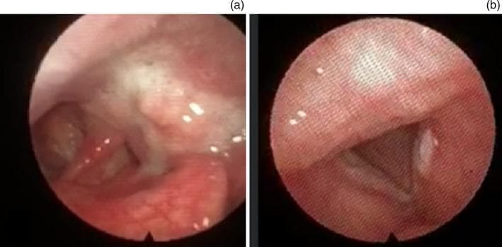 This clinical photograph displays two fiber-optic endoscopic views of the larynx and pharynx, illustrating primary malignancies. Panel (a) shows a nasendoscopic view of the left piriform fossa containing a fleshy, erythematous mass with an irregular, bumpy surface. The lesion demonstrates areas of white leukoplakia and prominent superficial vascularization, characteristic of piriform fossa squamous cell carcinoma. Panel (b) provides a view of the glottis showing the vocal cords in a narrow V-shaped configuration. A distinct, opaque, white exophytic mass is visible on the edge of the left vocal cord, representing a vocal cord squamous cell carcinoma. The images were captured using a smartphone-integrated flexible endoscope. These views are essential for otolaryngology training in identifying malignant upper aerodigestive tract lesions and distinguishing them from benign pathology through visual characteristics such as irregular margins, atypical color changes, and tissue distortion.