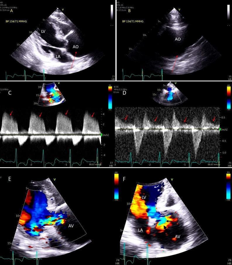 This diagnostic imaging panel consists of six transthoracic echocardiogram (TTE) frames (A-F) illustrating the pathology and hemodynamic assessment of severe aortic regurgitation (AR) caused by aortic root dilation. Frames A and B are 2D parasternal long-axis views demonstrating annulo-aortic ectasia, with markedly dilated and aneurysmal aortic sinuses contrasted against a relatively normal-sized ascending aorta distal to the sinotubular junction. Frame C provides a continuous-wave (CW) Doppler spectral trace showing a dense regurgitant envelope with a steep deceleration slope, indicating rapid pressure equalization and severe AR. Frame D shows CW Doppler at the proximal descending thoracic aorta, revealing holodiastolic (pandiastolic) flow reversal. Frame E is a color Doppler parasternal long-axis view showing a broad regurgitant jet originating from the aortic valve and occupying more than two-thirds of the left ventricular outflow tract (LVOT), with a wide vena contracta visible. Frame F utilizes color Doppler in an apical three-chamber view to demonstrate the flow convergence zone (PISA method) used for quantifying the effective regurgitant orifice area. The collection serves as a comprehensive educational guide for the multi-parametric echocardiographic assessment of valvular incompetence.