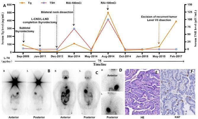 A multi-panel figure illustrating the clinical history and diagnostic findings of a patient with radioactive iodine-refractory differentiated thyroid cancer (RAIR-DTC). Panel A is a dual-axis timeline graph (Sept-2009 to Feb-2017) tracking serum Thyroglobulin (Tg) in ng/mL and Thyroid Stimulating Hormone (TSH) in uIU/mL alongside major interventions, including subtotal thyroidectomy, bilateral neck dissections, and multiple RAI treatments (100mCi each). Panels B and C show Radioactive Iodine (RAI) whole-body scans in anterior and posterior views. Scan B reveals functional iodine uptake in the neck, while Scan C demonstrates a lack of neck uptake but a new abnormal focus in the anterior-inferior mediastinum. Panel D provides localized anterior/posterior views clarifying the mediastinal focus. Panel E and F present histopathological sections: E shows Hematoxylin and Eosin (HE) staining at 200x magnification confirming papillary thyroid carcinoma morphology with papillary architecture; F shows immunohistochemical staining for Ki67, indicating a proliferative index of approximately 10%. The composite illustrates the progression of PTC from initial diagnosis through the development of RAI-refractoriness.