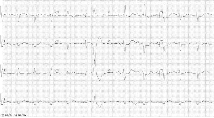This diagnostic image is a 12-lead electrocardiogram (ECG) showing cardiac rhythm and conduction abnormalities. The tracing displays an irregularly irregular ventricular rhythm with an absence of distinct P waves, replaced by low-amplitude, irregular fibrillatory waves (f-waves), diagnostic of atrial fibrillation. The QRS complexes are wide (duration >120 ms), particularly evident in the right precordial lead V1, which exhibits an rSR' pattern (M-shaped complex) and secondary ST-T wave changes, characteristic of a complete right bundle branch block (RBBB). Additionally, a premature ventricular contraction (PVC) is visible, characterized by a wide, bizarre QRS morphology and a compensatory pause. The limb leads show a leftward axis deviation. This ECG is a critical educational tool for identifying atrial fibrillation in the presence of pre-existing bundle branch blocks and ventricular ectopy, typically seen in patients with structural heart disease or cardiomyopathy.