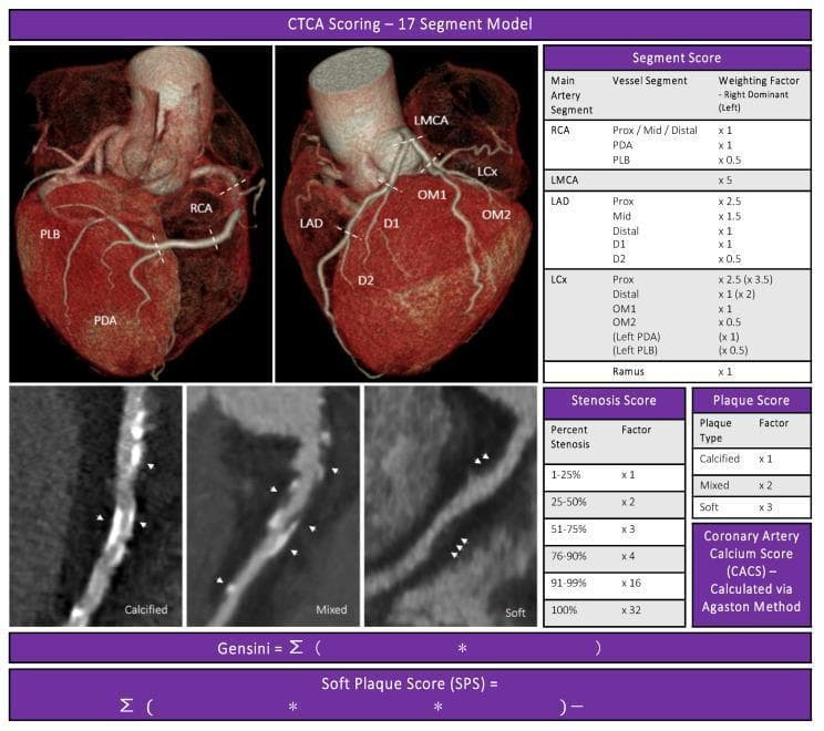 Educational infographic illustrating the CT Coronary Angiography (CTCA) semi-quantitative plaque scoring system, based on the Society of Cardiovascular Computed Tomography 17-segment model. The top section features two 3D volume-rendered heart reconstructions labeling key coronary anatomy: Right Coronary Artery (RCA), PDA, PLB, Left Main (LMCA), LAD, LCx, and branches D1/D2 and OM1/OM2. Tables define the Segment Score weighting factors for right and left dominance, and the Stenosis Score (1% to 100%). The bottom-left panels provide curved multiplanar reconstructions (cMPR) of coronary vessels showing three distinct plaque morphologies: 'Calcified' (high-attenuation/bright), 'Mixed' (heterogeneous density), and 'Soft' (low-attenuation/grey). A 'Plaque Score' table assigns multipliers (x1 for calcified, x2 for mixed, x3 for soft) to calculate the Soft Plaque Score (SPS) alongside the standard Gensini score and Agatston calcium score. This resource is designed for cardiology and radiology training on atherosclerotic burden assessment.