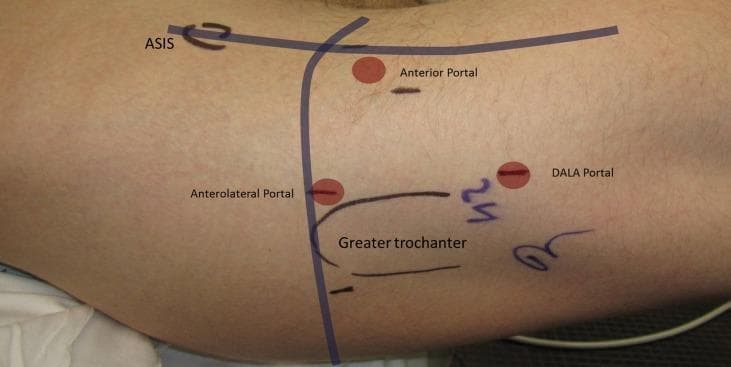 This clinical photograph illustrates the standard surface anatomy and portal placement for hip arthroscopy on a patient's right hip in a supine position. Key anatomical landmarks are marked on the skin, including the Anterior Superior Iliac Spine (ASIS) and the outline of the Greater Trochanter. Three primary arthroscopic portals are identified with red circular markers and labels: 1) The Anterolateral (AL) portal, situated approximately 1 cm anterior to the superior tip of the greater trochanter; 2) The Anterior portal, located at the intersection of a horizontal line from the AL portal and a vertical line distal to the ASIS; and 3) The Distal Anterolateral Accessory (DALA) portal, positioned distal and posterior to the AL portal. Reference lines are drawn to demonstrate the geometric relationship between these landmarks, ensuring safe surgical access to the central and peripheral compartments of the hip joint while avoiding neurovascular structures such as the lateral femoral cutaneous nerve and the superior gluteal nerve.