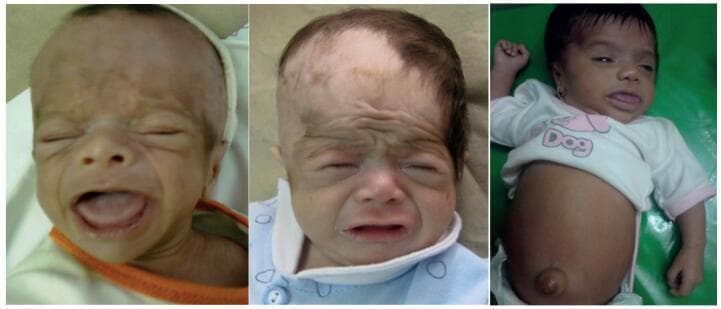 This clinical photograph displays a three-panel series of infants illustrating classic physical manifestations of untreated congenital primary hypothyroidism at three months of age. The first two panels focus on facial features, showing coarse facial features, puffy eyelids (periorbital edema), and a characteristic 'myxedematous' facies. Notably, the infants exhibit a flat nasal bridge, macroglossia (an enlarged, protruding tongue), and thickened skin with prominent forehead wrinkling. The third panel shows an infant with a markedly distended abdomen and a prominent umbilical hernia, another hallmark sign of the condition. Additional visible indicators include sparse hair and an overall lethargic or dull appearance. These images serve as a pedagogical example of the clinical progression of hypothyroidism in infants who missed neonatal screening, highlighting the multisystemic physical signs that accompany developmental delay and metabolic insufficiency in early infancy.