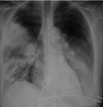 This diagnostic image is a posterior-anterior (PA) view chest X-ray demonstrating multifocal pneumonia with prominent consolidations. In the right lung, there is dense consolidation involving the upper lobe, characterized by increased radiopacity that obscures the regional vascular markings. Patchy, ill-defined airspace opacities are also visible extending into the right lower lobe. The left lung field reveals significant consolidation primarily localized within the lower lobe, partially obscuring the left hemidiaphragm silhouette. The cardiac silhouette appears normal in size, and the trachea is midline. The visual findings are consistent with severe pulmonary infection, such as atypical pneumonia (e.g., Legionella species). This clinical imaging serves as an educational example of multifocal bacterial consolidation and its radiographic distribution in the context of acute respiratory distress and sepsis.