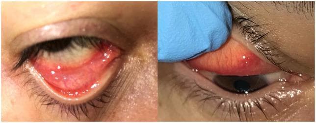 Clinical photograph showing an ophthalmological examination of a right eye. The image consists of two side-by-side panels demonstrating the eversion of the lower and upper eyelids to inspect the palpebral conjunctiva. Key visible clinical signs include pronounced conjunctival injection (redness) and mild chemosis (edema of the conjunctiva). A follicular reaction is evident, characterized by multiple small, raised, translucent bumps within the upper and lower conjunctival fornices. Additionally, a clear serous secretion is visible, indicating a non-purulent inflammatory process. The cornea appears clear in the visible portions. These findings are typical of acute follicular conjunctivitis, which in this clinical context was identified as a manifestation of viral infection, specifically SARS-CoV-2. The image serves as an educational reference for identifying follicular patterns and inflammatory changes in viral conjunctivitis.