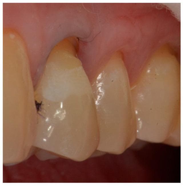 This clinical intraoral photograph demonstrates a Non-Carious Cervical Lesion (NCCL) following the enamel-dentin etching process. The primary focus is on a premolar tooth exhibiting a wedge-shaped cervical defect. Post-etching with phosphoric acid, the cervical enamel displays a characteristic 'frosty' or chalky white, opaque appearance, indicating the creation of microporosities and a change in the refractive index for optimized bonding. The gingival margin shows moderate recession and slight inflammation, with blunted interdental papillae. Small dark spots at the coronal margin of the NCCL may represent dental caries or minor debris. A retraction cord or thin foreign fibers are visible in the gingival sulcus area, typically used to manage moisture and provide better access to the cervical margin during restorative dental procedures. The image serves as an educational example of substrate preparation in adhesive dentistry for managing NCCLs and gingival recession.