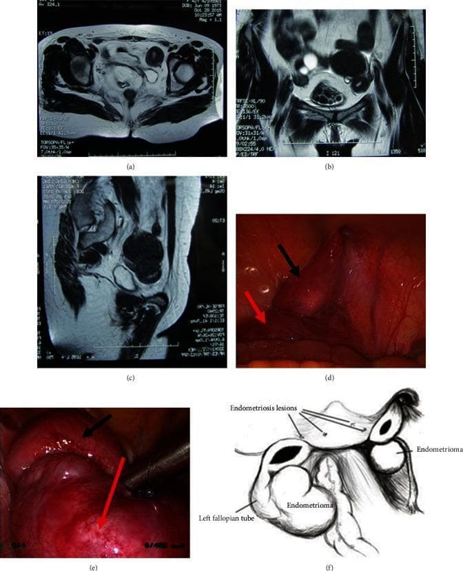 This composite figure illustrates the diagnostic and surgical findings of a patient with Müllerian duct anomalies, specifically Mayer-Rokitansky-Küster-Hauser (MRKH) syndrome type II with functional rudimentary uteri. Panels (a)-(c) present multi-planar pelvic MRI scans (axial, coronal, and sagittal) demonstrating bilateral rudimentary uteri with visible endometrial signal and associated low-signal adnexal cystic masses. Panels (d) and (e) are intraoperative laparoscopic photographs showing the reddish, smooth-surfaced rudimentary uterine horns (black arrows) and large ovarian chocolate cysts (red arrows), consistent with pelvic endometriosis. Panel (f) provides a labeled anatomical diagram summarizing the surgical findings: bilateral residual uteri of disparate sizes (left 6-7 cm, right 2-3 cm), bilateral ovarian endometriomas, and the left fallopian tube. This collection serves as an educational tool for identifying ectopic endometrial tissue and functional uterine remnants in the context of congenital vaginal agenesis and secondary periodic pelvic pain.