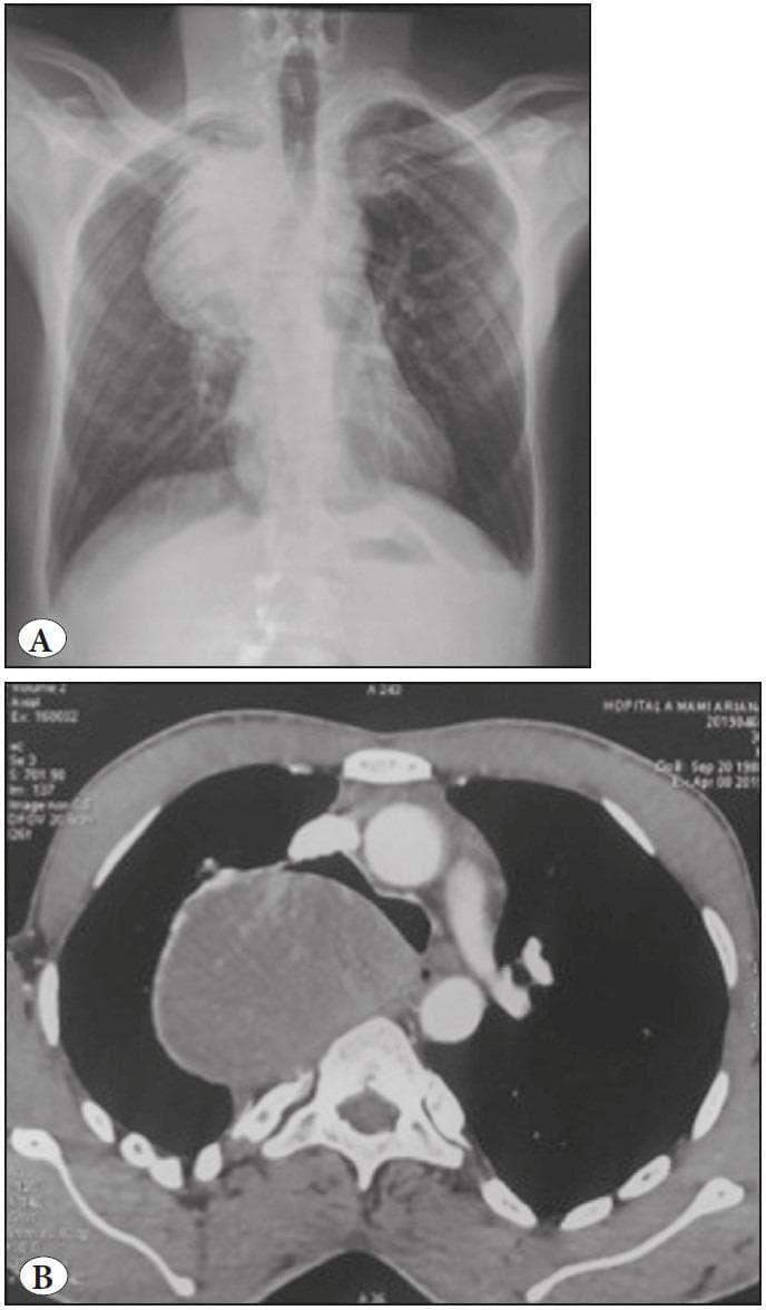 The visual includes two diagnostic images of a chest pathology: Panel A is a posterior-anterior (PA) chest X-ray and Panel B is an axial computed tomography (CT) scan. In the chest X-ray, a prominent, well-defined latero-tracheal radiopaque shadow is visible in the upper right mediastinum, measuring approximately 10 cm in diameter, causing slight tracheal deviation. The axial CT scan with contrast (Panel B) further characterizes this finding as a large, hypoattenuating mass located in the posterior mediastinum. The mass measures approximately 82x68 mm and is in close anatomical contact with the D2 and D4 vertebral bodies. It appears encapsulated and lacks clear signs of costal invasion or significant lymphadenopathy. This visual set is used to demonstrate the diagnostic workup for mediastinal tumors, specifically illustrating the presentation of a bronchogenic cyst that has undergone malignant degeneration. This case provides educational value for thoracic imaging, surgical pathology, and differential diagnosis of mediastinal masses in adult patients.