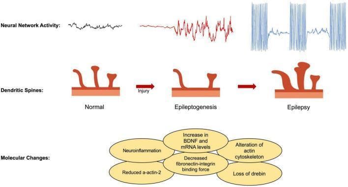 This pathophysiology diagram illustrates the progression of epilepsy through three stages: Normal, Epileptogenesis, and Epilepsy, focusing on neural network activity, dendritic spine morphology, and underlying molecular changes. The top row depicts the evolution of electrical activity from low-amplitude, irregular baseline fluctuations (Normal) to increased amplitude oscillations (Epileptogenesis, red) and finally to high-frequency, paroxysmal spike-and-wave discharges characteristic of seizures (Epilepsy, blue). The middle row shows anatomical changes in dendritic spines following an initial 'Injury'. The 'Normal' stage displays healthy mushroom-shaped and thin spines. 'Epileptogenesis' shows a reduction in spine density and morphological atrophy. The 'Epilepsy' stage demonstrates aberrant spine regrowth or remodeling, showing thickened, dysmorphic spines. The bottom section lists key molecular drivers of this progression within overlapping oval nodes, including neuroinflammation, increased BDNF and mRNA levels, alteration of the actin cytoskeleton, reduced alpha-actin-2, decreased fibronectin-integrin binding force, and loss of drebin. This illustration is intended for medical education regarding the neurobiological mechanisms of seizure development and synaptic plasticity.