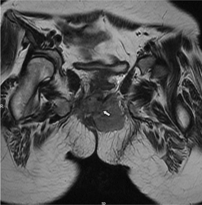 This diagnostic image is an axial T2-weighted magnetic resonance imaging (MRI) scan of the human pelvic region, specifically focusing on the pelvic floor anatomy. The image demonstrates a significant soft tissue mass representing a tumor, likely rhabdomyosarcoma, which has extensively infiltrated the pelvic musculature. Key findings include the replacement of the normal hypointense signal of the puborectalis muscle with a heterogeneous, hyperintense tumor signal. Furthermore, there is clear bilateral involvement of the levator ani muscles (indicated by the white arrow), leading to a marked loss of normal muscle morphology and anatomical symmetry. The mass is positioned centrally within the posterior pelvic floor, compressing adjacent structures. This image is clinically significant for staging pelvic soft tissue sarcomas and evaluating the invasion of the anal sphincter complex and levator ani, which are critical for determining surgical resectability and treatment planning in oncology.