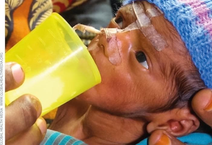 Clinical photograph of a preterm infant receiving nutritional support in a neonatal care setting. The image demonstrates a 'cup feeding' technique, an alternative oral feeding method for infants who cannot be directly breastfed. A healthcare provider or caregiver is shown holding a small, translucent yellow cup containing an opaque, off-white liquid (likely expressed breast milk or formula) to the infant's lips. The infant exhibits several medical devices and clinical features including a nasogastric or orogastric tube secured with adhesive medical tape across the cheek and nasal bridge for enteral feeding. Protective adhesive dressings are also visible on the forehead. The infant is wearing a knitted cap to assist with thermoregulation, a critical component of neonatal care. This visual illustrates neonatal nutritional management and the use of supplemental feeding implements in resource-limited or specific clinical scenarios where direct breastfeeding is not possible.