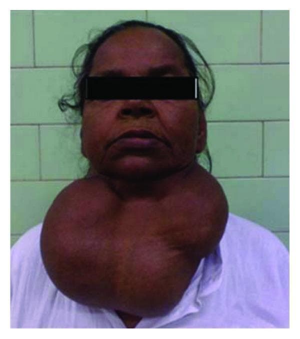 This clinical photograph shows a frontal view of an adult female patient with an exceptionally large multinodular goiter. The thyroid swelling is massive, occupying the entire anterior and lateral aspects of the neck. Anatomically, the mass extends superiorly from the submental region and lower jawline to inferiorly below the level of the sternal notch. The swelling exhibits a distinct lobulated morphology, consistent with a chronic multinodular goiter. The overlying skin appears intact without visible ulceration, significant erythema, or prominent superficial venous distension. The sheer size of the mass relative to the patient's head illustrates significant displacement of local anatomy, which is often associated with obstructive symptoms such as dyspnea or dysphagia. This image serves as a clinical example of severe endocrine pathology and is relevant for studies in endocrinology, general surgery, and anesthesiology regarding airway management and thyroidectomy.