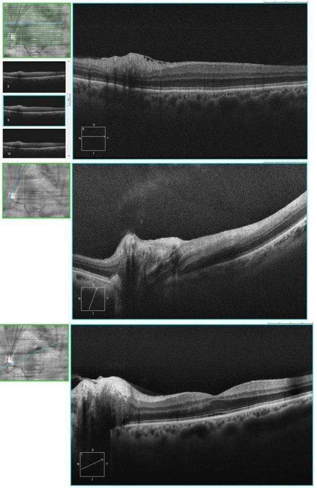 This diagnostic image displays three cross-sectional Optical Coherence Tomography (OCT) scans of the human retina and optic nerve head. The scans demonstrate diagnostic imaging of the posterior segment, focusing on the peripapillary region. Key clinical features include focal hyperreflectivity of the internal retinal layers, specifically involving the nerve fiber and ganglion cell layers, which indicates acute ischemic changes or cotton-wool spot formation. The optic nerve head exhibits varying degrees of contour distortion and elevation, most prominent in the middle scan where there is significant disc swelling or protrusion. Notably, the deeper retinal layers and the underlying macula appear relatively preserved without evidence of subretinal fluid or significant macular edema. Each panel includes a small fundus reference map on the left to indicate the orientation and specific location of the B-scan line. This visual material is intended for ophthalmology education regarding retinal vascular disorders and optic nerve pathology, emphasizing the correlation between structural elevation and altered reflectivity in acute clinical presentations.